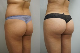 Buttock-Lift-in-Abu-Dhabi-Before-After
