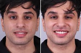 Composite-Veneers-1