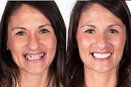 Composite-Veneers-in-Abu-Dhabi-1