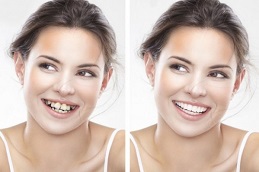 Crowded-Teeth-Treatment