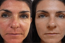 Fotona Twin Light Fractional Rejuvenation Clinic in Abu Dhabi 1