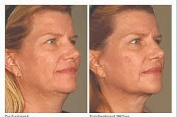 Fotona-Twin-Light-Fractional-Rejuvenation-in-Abu-Dhabi-UAE
