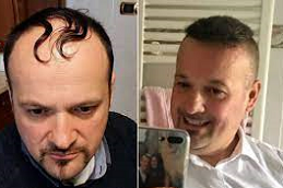 Hybrid-hair-transplant