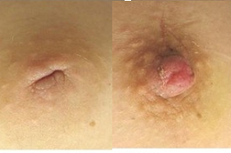 Inverted-Nipple-Surgery-Cost-in-Abu-Dhabi