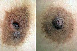 Inverted-Nipple-surgery
