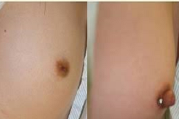 Inverted-NippleSurgery-Clinic-in-UAE