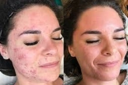 Organic-Pumpkin-Peel-in-Abu-Dhabi-Al-Ain