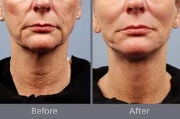 Skin-Tightening-Contouring (1)
