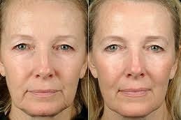 Skin-Tightening-Contouring-in-Abu-Dhabi-Al-Ain