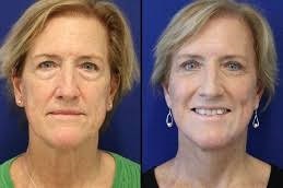 Skin-Tightening-Contouring-in-Abu-Dhabi