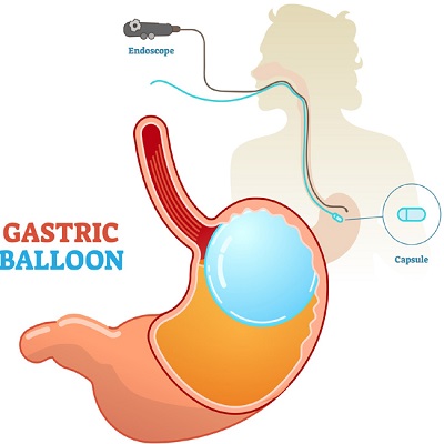تكلفة عملية بالون المعدة في دبي وأبو ظبي والشارقة والعين
