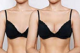 حقن البوتوكس لتكبير الثدي في دبي وأبو ظبي والشارقة