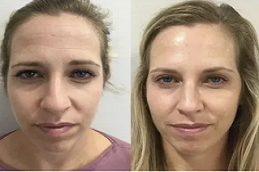 أفضل تكلفة حقن البوتوكس في دبي أبو ظبي والشارقة والعين