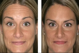 أفضل تكلفة حقن البوتوكس في دبي أبو ظبي والشارقة والعين