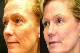 أفضل تكلفة حقن البوتوكس في دبي أبو ظبي والشارقة والعين