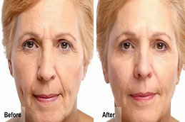 أفضل تكلفة حقن البوتوكس في دبي أبو ظبي والشارقة والعين