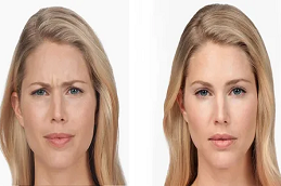 أفضل تكلفة حقن البوتوكس في دبي أبو ظبي والشارقة والعين