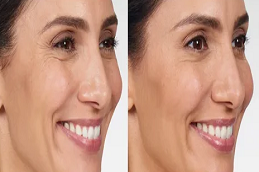 أفضل تكلفة حقن البوتوكس في دبي أبو ظبي والشارقة والعين