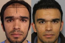 تكلفة زراعة الشعر في دبي وأبو ظبي والشارقة