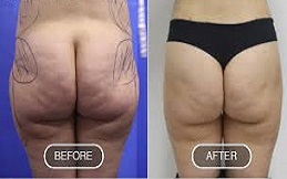 تكلفة تكبير الأرداف في دبي