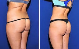 تكلفة تكبير الأرداف في دبي