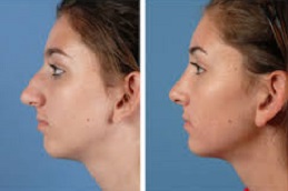 تكلفة تجميل الأنف في دبي