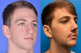 تكلفة تجميل الأنف في دبي