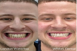 Composite Bonding Before And After Cosmetic 1 1