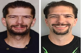 زراعة الأسنان في دبي وأبو ظبي والشارقة والعين