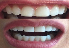 تدعيم الأسنان الرابطة في دبي وأبو ظبي والشارقة والعين