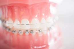 نظام تقويم الأسنان دامون في دبي وأبو ظبي والشارقة والعين