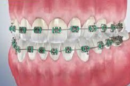 أفضل تقويم الأسنان المعدني في دبي وأبو ظبي والشارقة والعين
