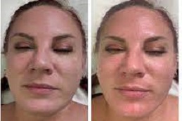 علاج هيدرا فيشل في دبي وأبو ظبي والشارقة والعين