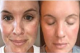 علاج تجديد الجلد في دبي وأبو ظبي والشارقة والعين