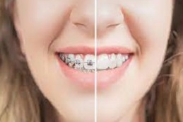 أفضل تقويم الأسنان المعدني في دبي وأبو ظبي والشارقة والعين