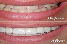الجسر التجميلي في دبي وأبو ظبي والشارقة والعين