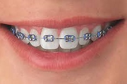 أفضل تقويم الأسنان المعدني في دبي وأبو ظبي والشارقة والعين