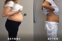 إبر مونجارو في الإمارات