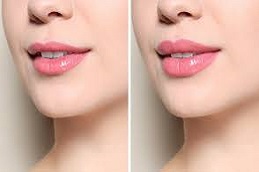 جهاز فوتونا رباعي الأبعاد لتجميل الشفاه في دبي وأبو ظبي والشارقة والعين