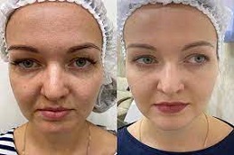 تقشير الكربون بالليزرفي دبي وأبو ظبي والشارقة والعين