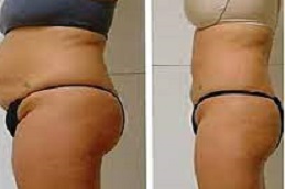 Laser lipolysis treatment in Dubai, Abu Dhabi, Sharjah and Al Ain