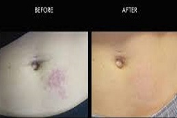 عملية إزالة الوحمات في دبي وأبو ظبي والشارقة والعين