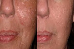 إزالة الندبات بالليزر في دبي وأبو ظبي والشارقة والعين