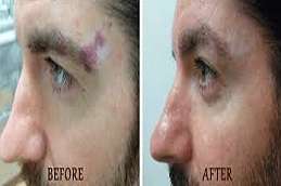 عملية إزالة الوحمات في دبي وأبو ظبي والشارقة والعين