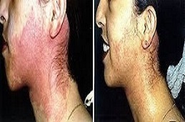 علاج إزالة بقع النبيذ في دبي وأبو ظبي والشارقة والعين