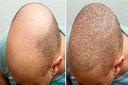 تكلفة زراعة الشعر في دبي وأبو ظبي والشارقة والعين