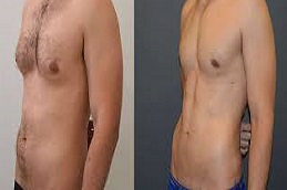 جراحة شفط الدهون في دبي وأبو ظبي والشارقة والعين