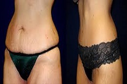 شد البطن المحيطي شد البطن المحيطي في دبي وأبوظبي والشارقة والعين