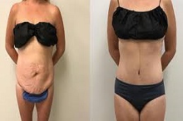 شد البطن المحيطي في دبي وأبوظبي والشارقة والعين