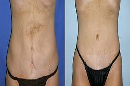 شد البطن المحيطي في دبي وأبوظبي والشارقة والعين